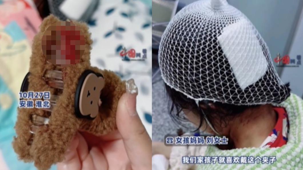 上廁所突滑倒!13歲少女「鯊魚夾破頭」 濺血慘縫3針