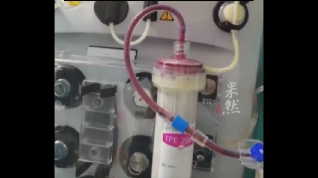 愛嗑外食突上吐下瀉！19歲男血脂飆百倍　血液抽出「全奶白」