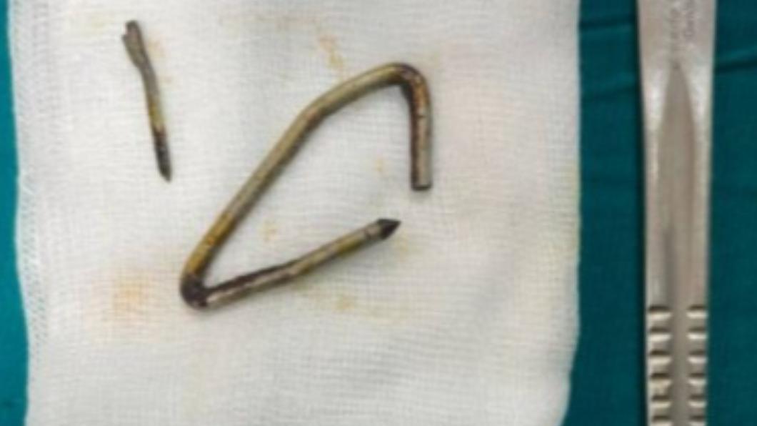 鐵釘長達6公分。(圖/翻攝自Urology Case Reports)