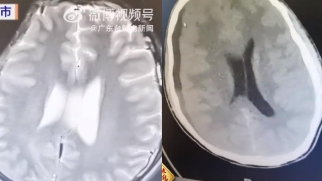 男子牙齒發炎進而影響到腦部。（圖／翻攝自@微博視頻號）