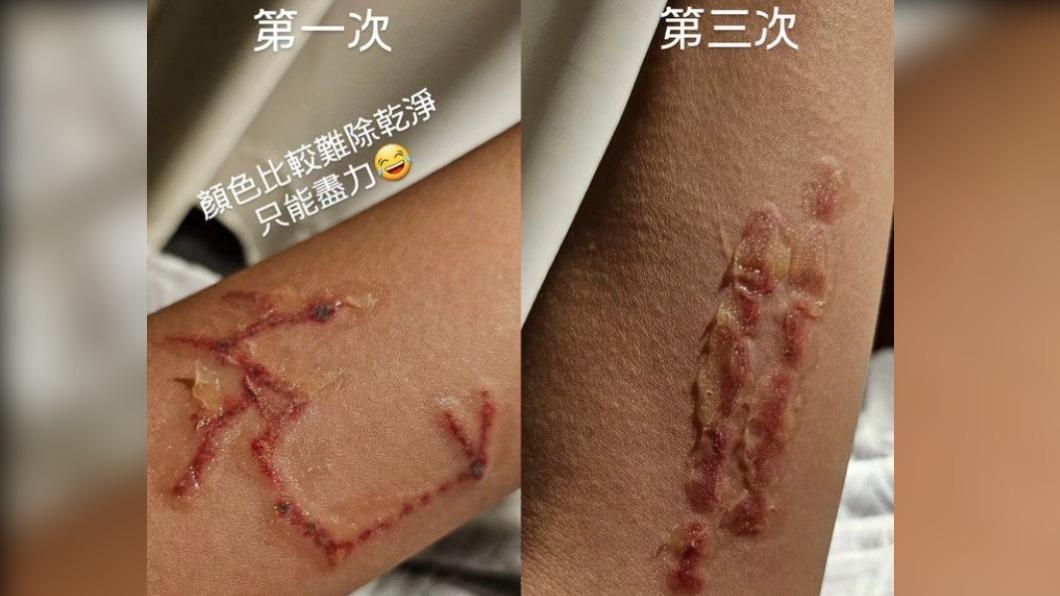 阿圓透露傷口像是臭灰達。(圖/翻攝自一隻阿圓 IG)