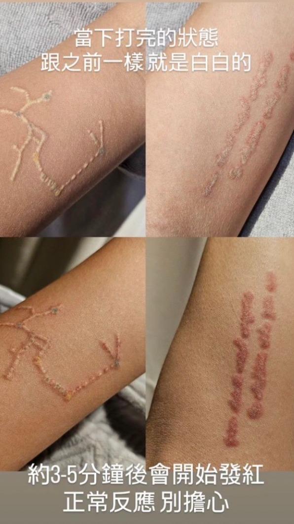 阿圓第三次除掉左手刺青。(圖/翻攝自一隻阿圓 IG)
