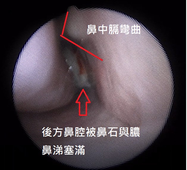 婦人因鼻中膈彎曲,導致後方鼻腔遭卡死。(圖/翻攝自陳亮宇醫師 / 陳亮宇耳鼻喉科診所臉書)