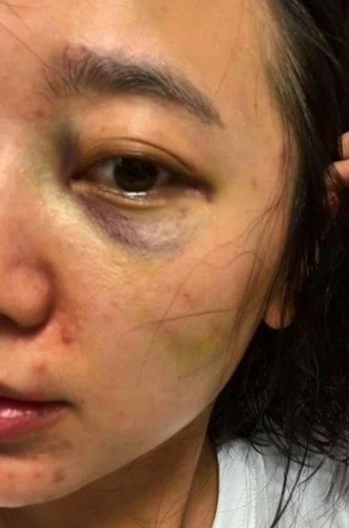 徐莎朗去年曬出眼睛瘀青照。(圖/翻攝自徐莎朗IG)