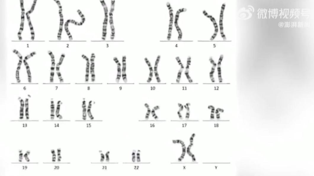 醫生說明,「46,xx」男性症候群發生率約2萬分之一。(圖/翻攝自《澎湃新聞》)