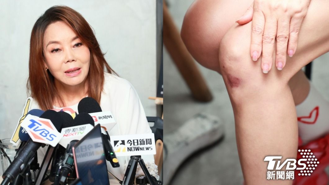 辛曉琪還原受傷經過,無奈說當時還到傷燙傷中心治療。(圖/趙世平攝)