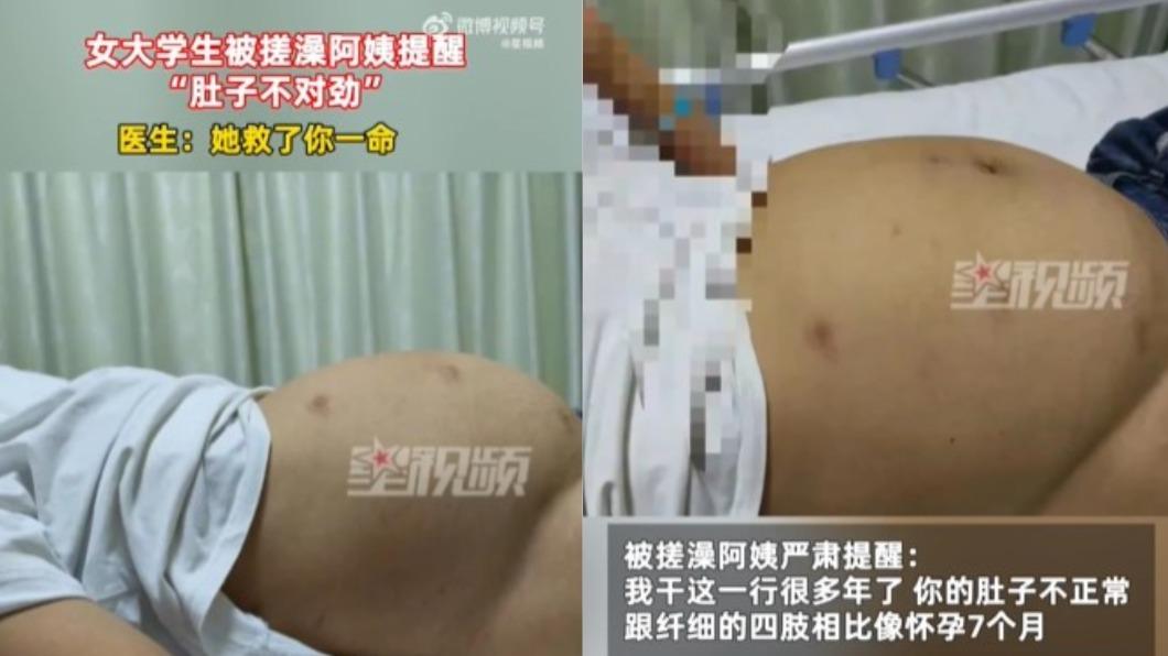 以為只是胖!女大生肚超大「藏20公分巨瘤」 聽搓澡阿姨1句救命