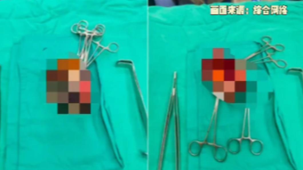 陸婦臉小黑點變十公分腫瘤「內藏蠕動蛆蟲」 醫嘆:拖太久