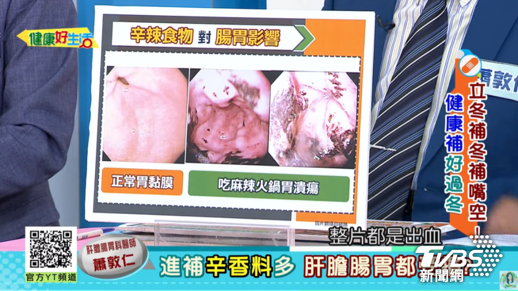 35歲工程師吃麻辣火鍋吃到出血性胃潰瘍、胃發炎。（圖／翻攝自健康好生活YouTube）