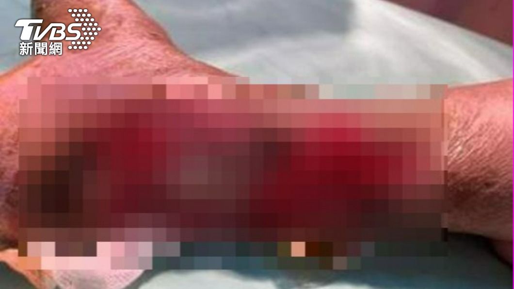 台中婦糖尿病腳潰爛「深可見骨」 還自行抹藥險遭截肢