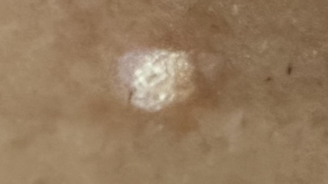 病毒疣會接觸感染。(圖/診所提供)