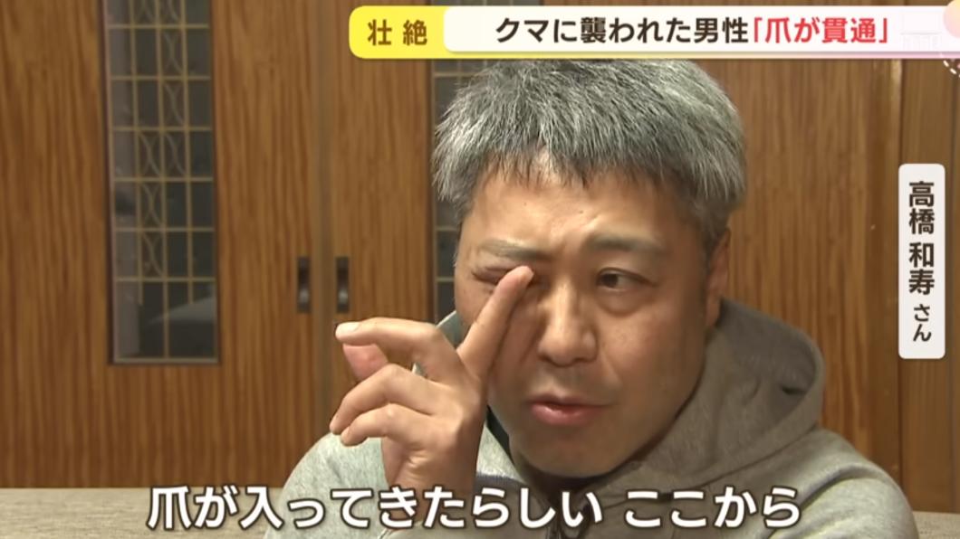 高橋和壽的眼部也受傷。（圖／翻攝自HTB北海道ニュース YT頻道）