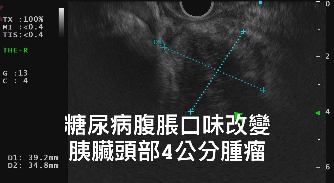 胰臟內視鏡超音波檢查發現,老翁胰臟頭部有一顆接近4公分腫瘤。(圖/翻攝自林相宏醫師臉書)