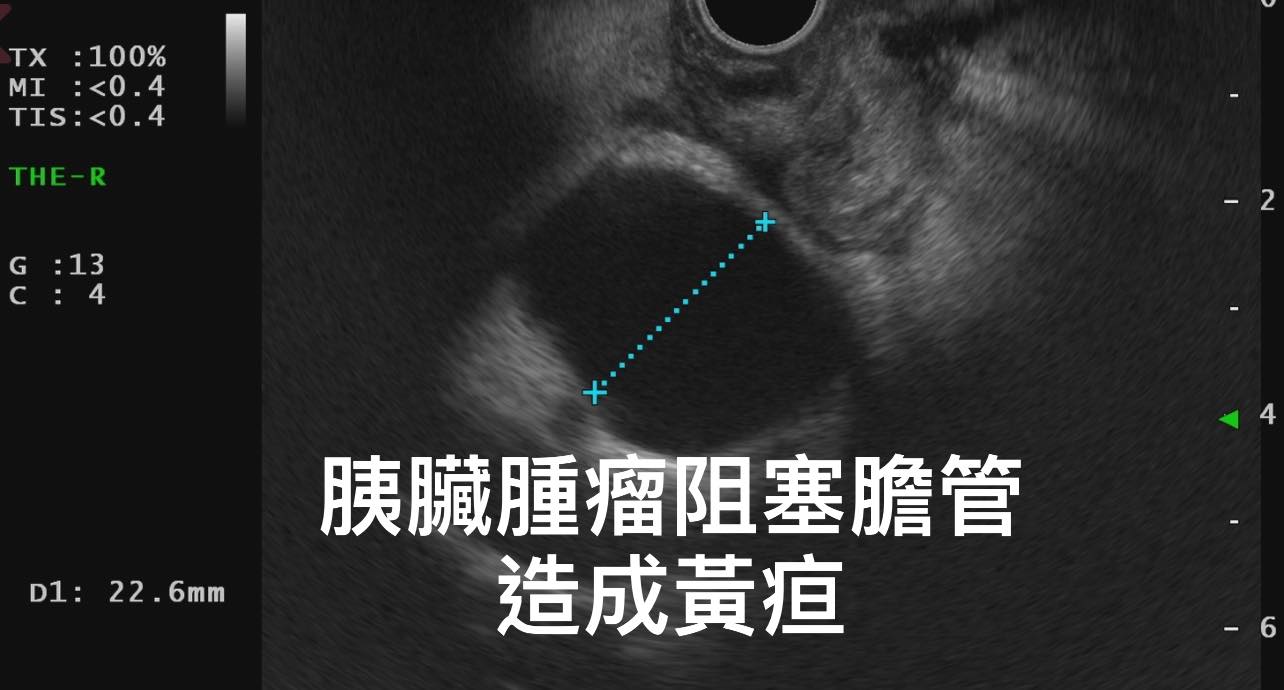 老翁胰臟腫瘤造成膽汁和胰臟阻塞。(圖/翻攝自林相宏醫師臉書)