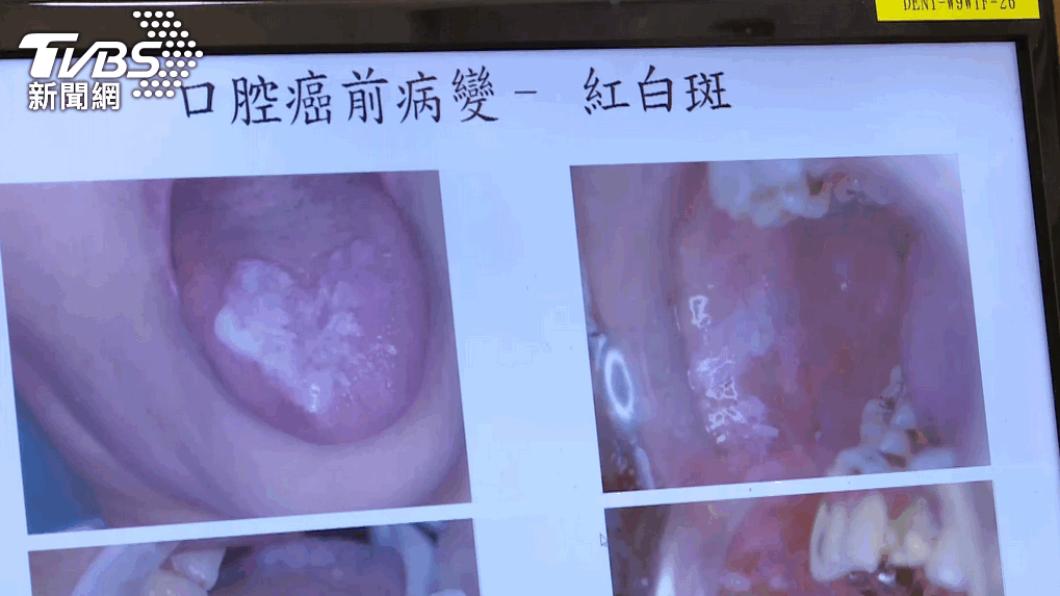 長期嚼食檳榔，易導致口腔癌。（圖／TVBS）