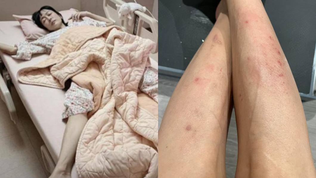 胃癌末期開刀續命!唐玲爆健康又出狀況「全身一片紅」 病況照曝光