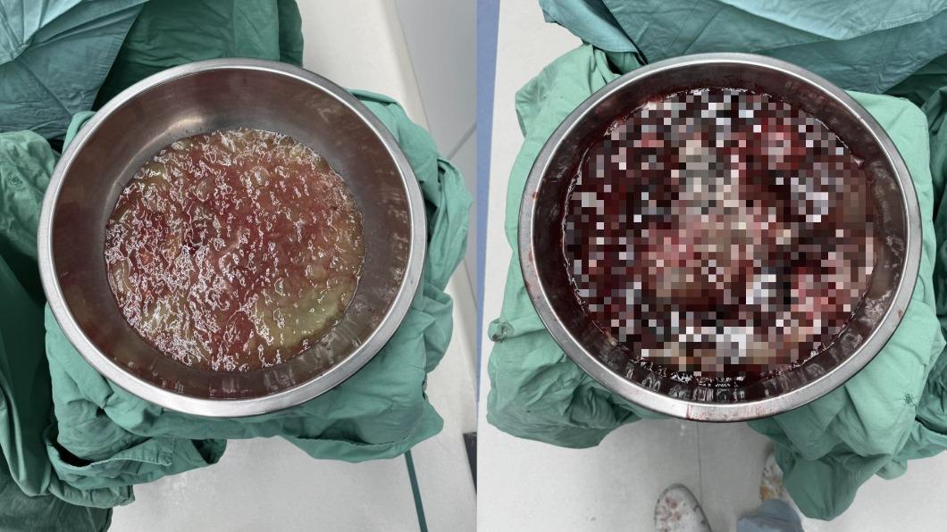 她半年腹部速脹大!一剖「紅黃黏液炸出」 醫徒手狂挖4kg