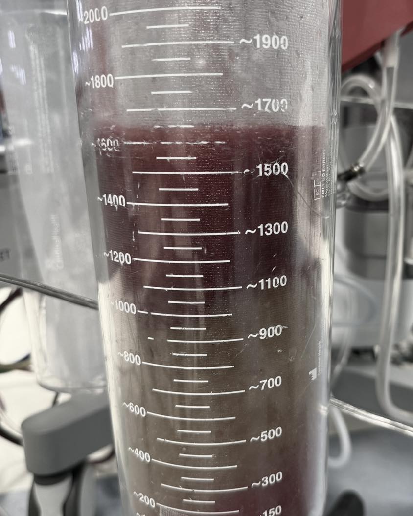 女子卵巢腫瘤破了一個拳頭大的洞且黏液不斷從裡面流出。(圖/已取得Dr. 李偉浩 的 婦科手術室 授權)