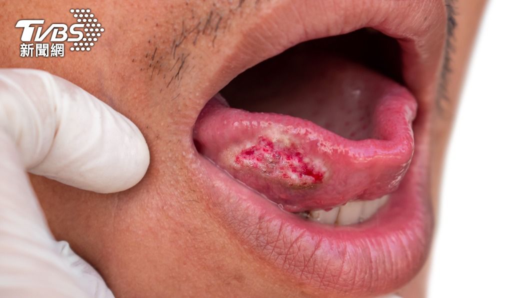 如若口腔中有不容易癒合的潰傷或是斑要迅速就醫。(示意圖/shutterstock達志影像)