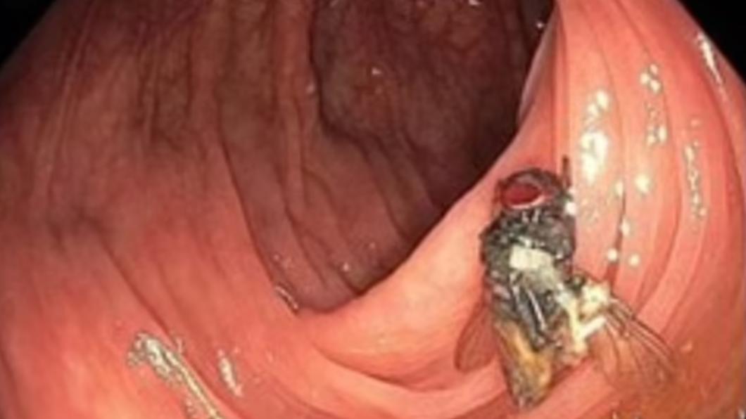 男大腸鏡檢查驚見「完整蒼蠅停腹中」 疑蛆藏蔬菜在肚中長成蟲