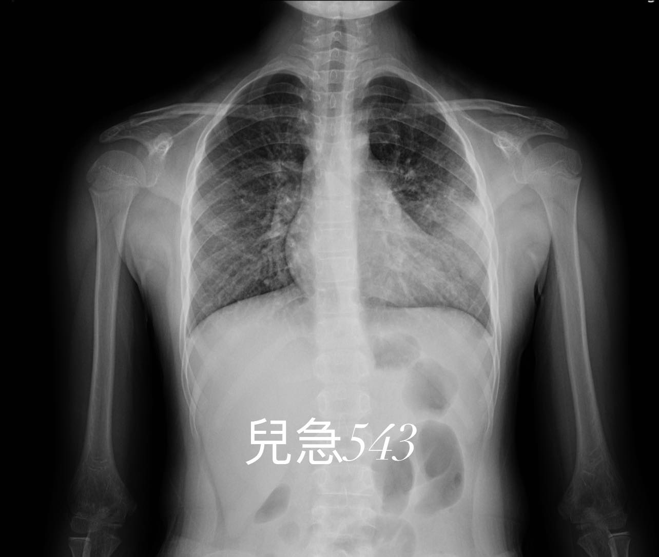肺炎黴漿菌為一種非典型細菌,透過飛沫傳播常造成呼吸道輕微感染。(圖/翻攝自吳昌騰醫師臉書)