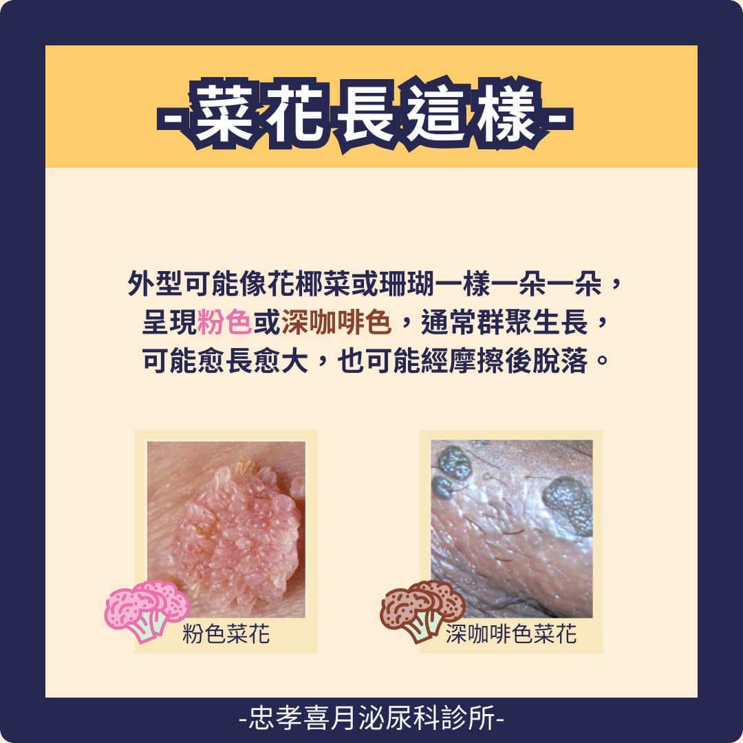 菜花外型可能花椰菜,或是珊瑚一樣。(圖/翻攝自忠孝喜月泌尿科診所臉書)