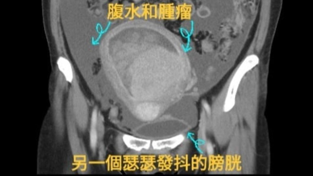 婦人因腹脹而發現骨盆腔腫瘤及腹水。(圖/泌尿科戴定恩醫師授權提供)