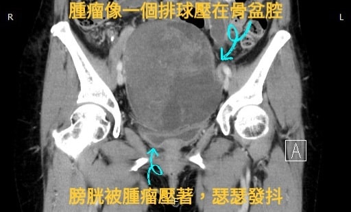 婦人因頻尿就診竟發現下腹有超大硬塊。(圖/泌尿科戴定恩醫師授權提供)