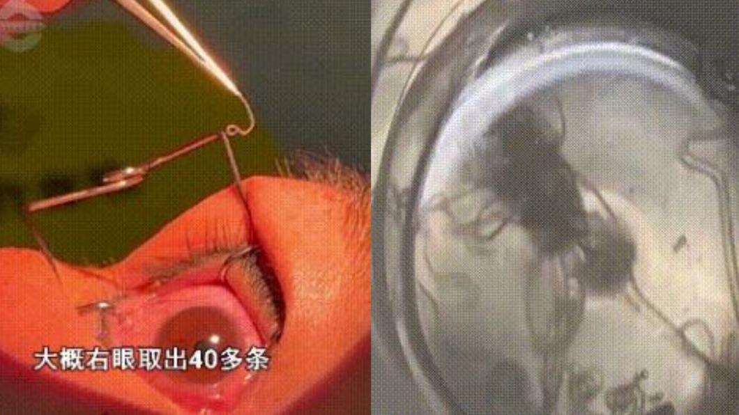 女子就醫檢查才發現，眼中竟有60多條的寄生蟲。（圖／翻攝自《沸時新聞》微博）