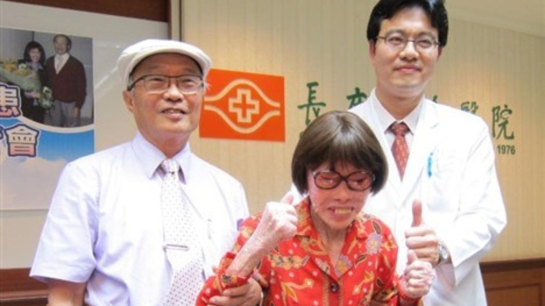 多次來台治療！「穿山甲人」張四妹病情惡化離世　享壽76歲
