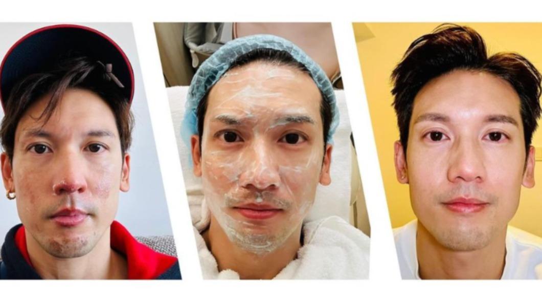 家中瓦斯外洩!關智斌頭髮、眉毛慘燒焦 親曝「二級燒傷毀容照」