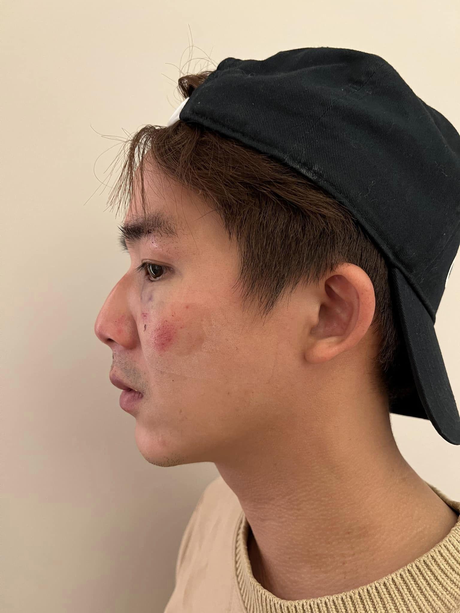 李博翔遭揍傷。(圖/翻攝自李博翔臉書)