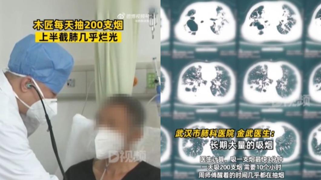 1天10包菸才夠!他「清醒都在抽」 醫傻眼:肺已變爛抹布