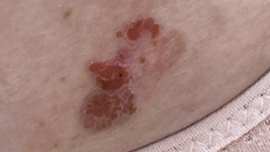 65歲婦女,身上有一個不規則的脫屑紅色病灶,由於不癢不痛,所以不以為意。(圖/北市聯醫提供)