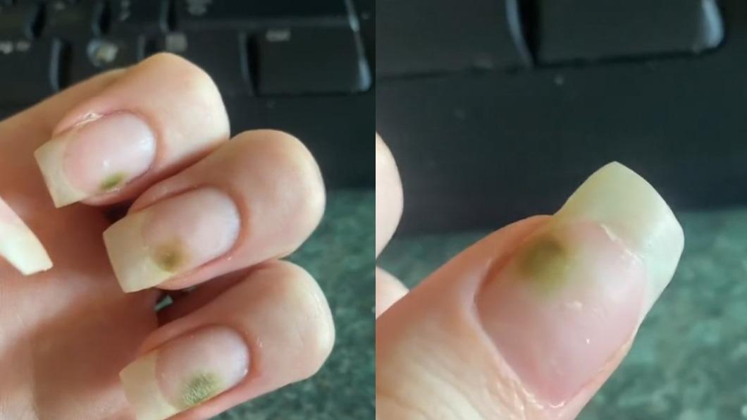 美甲沒卸竄黴斑！女大生崩潰曬「滿手青苔」：完全洗不掉