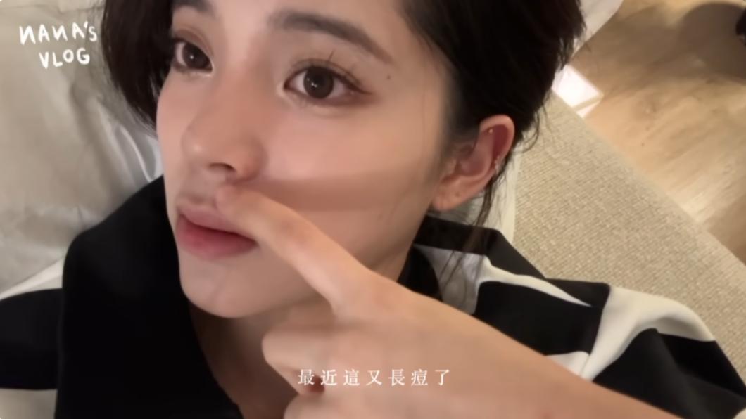 歐陽娜娜因課業繁重，無法好好睡覺的她長痘痘又冒疹子。（圖／翻攝自歐陽娜娜YouTube）