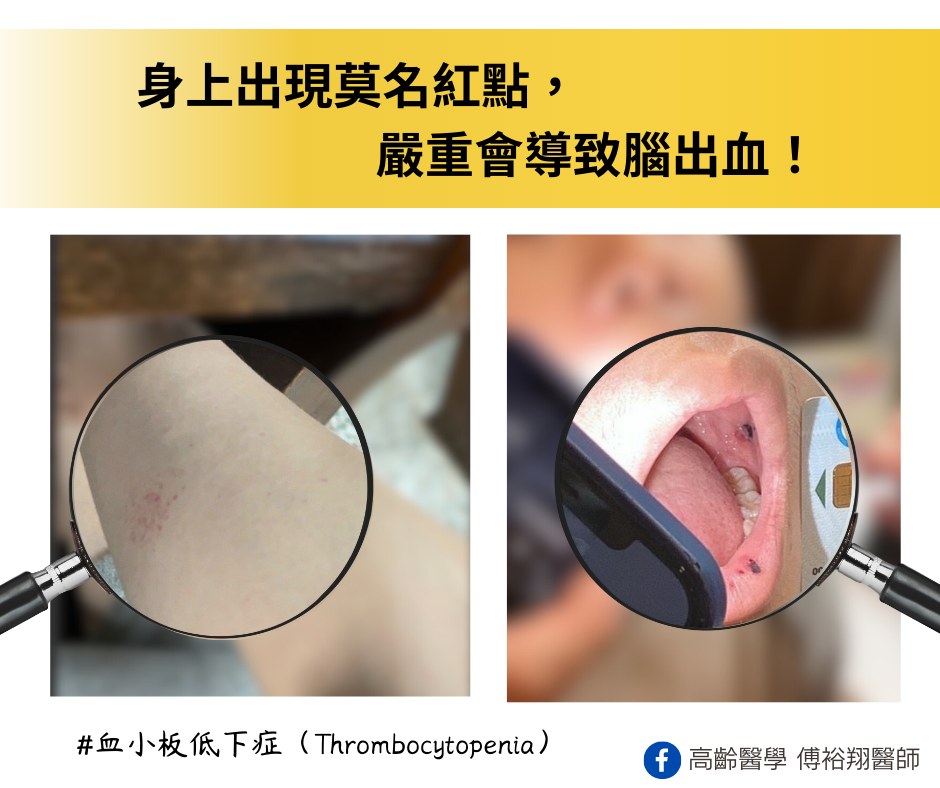 身上出現莫名紅點恐是血小板減少警訊,嚴重會導致腦出血。(圖/翻攝自傅裕翔臉書)