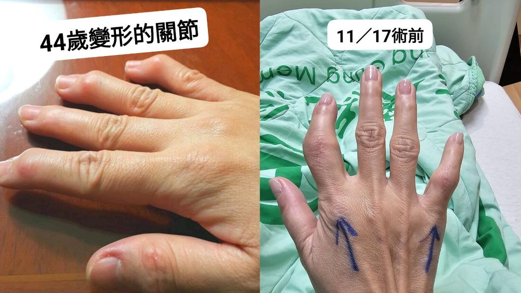 王瑞玲透露自己在44歲發病,手指關節開始發炎。(圖/翻攝自王瑞玲醫藥美食記者臉書)