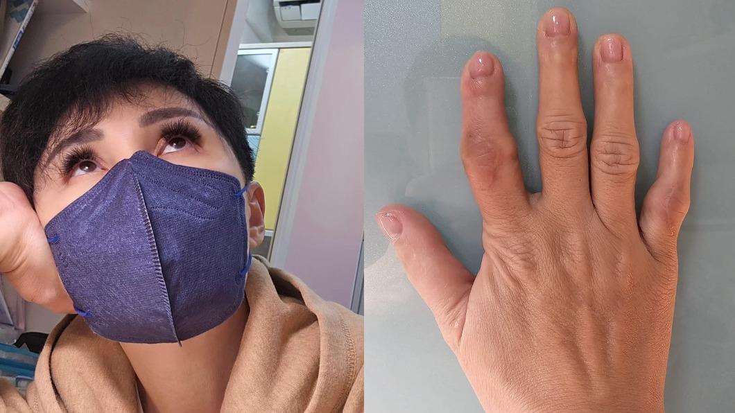 懂周海媚病苦!她10年抗戰紅斑性狼瘡 「關節變形」雙手成雞爪