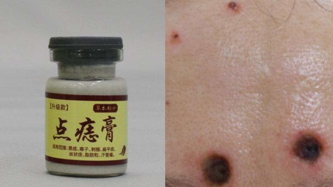 陸製點痣膏含強鹼 4日本人用後皮膚潰爛灼傷「受不可逆傷害」