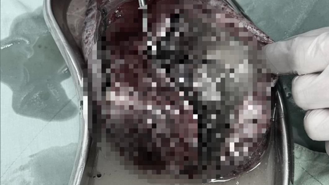 醫師稱該腫瘤中還有頭髮、油脂、指甲等組織。(圖/翻攝自Dr. 李偉浩 的 婦科手術室臉書粉專)