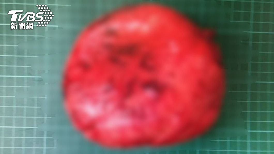 小黃運將便祕「屁味臭薰」乘客 竟是肚子裡藏了顆大肉瘤
