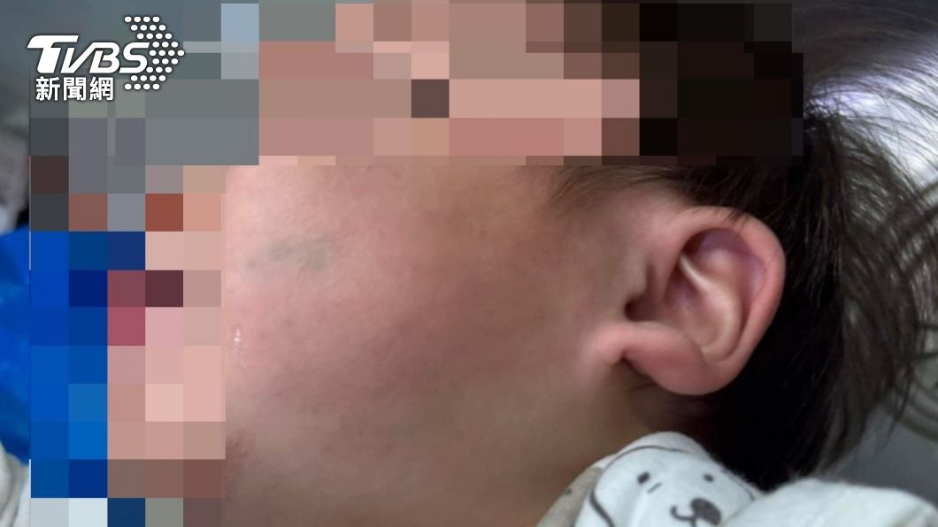 花蓮1歲嬰遭保母丈夫毆打　全身多處瘀青「顏面骨裂」半夜驚哭