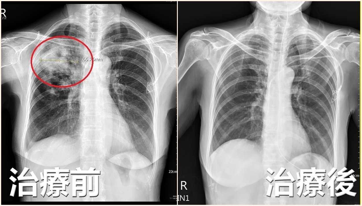 婦人化療後肺部開個洞，醫師提醒注意隱球菌症風險。（圖／亞大醫院提供）