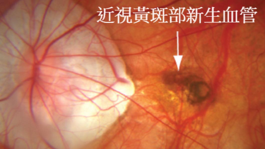 近視恐容易引發黃斑部病變、青光眼等。(圖/北市聯醫提供)