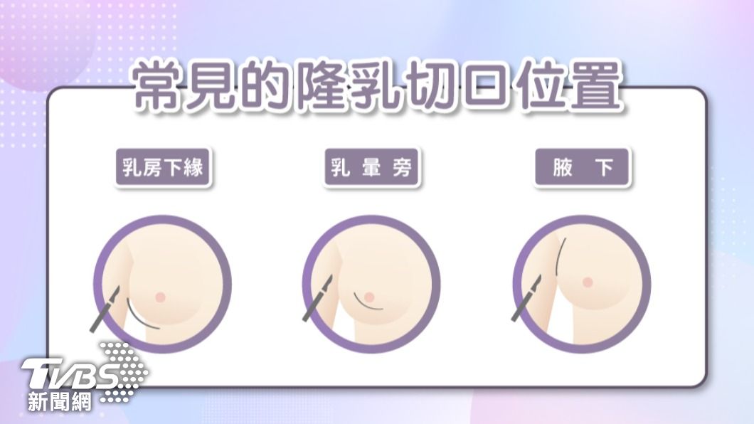 常見的隆乳切口位置。(圖/星采整形外科診所)
