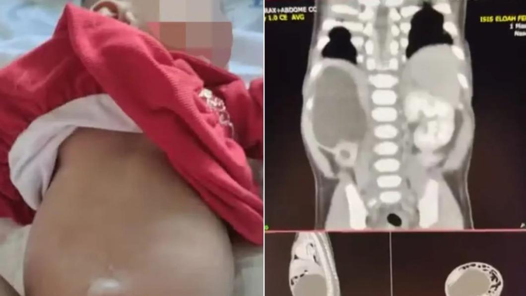 超罕見!巴西女嬰「出生就有4顆腎」 醫生曝:全球不到百人