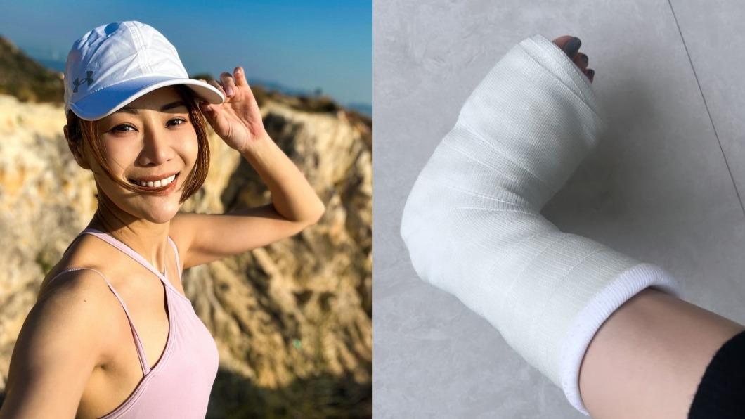 爬山出意外!女星忍劇痛8天求醫驚是「骨裂」 打石膏傷勢曝