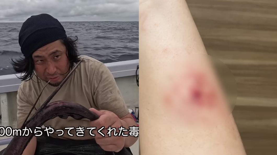 以身試毒!巨大深海魟魚毒針刺日男手臂 5小時後傷口慘狀曝