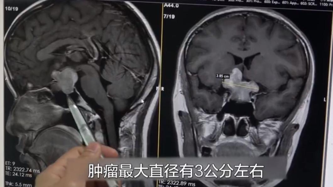 女大生就醫檢查後才發現,腦部長了一顆3公分大的垂體瘤。(圖/翻攝自《江蘇新聞》微博)